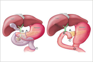 Surgery: Whipple Procedure - Let's Win Pancreatic Cancer