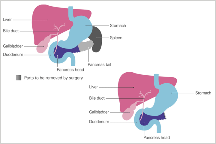 distal pancreatectomy diagrams