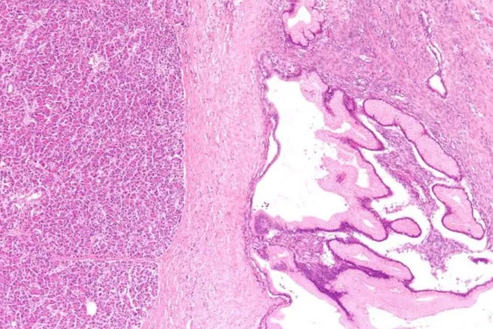 Low magnification micrograph of a benign mucinous tumour of the pancreas, also benign pancreatic mucinous cystic neoplasm, stained pink