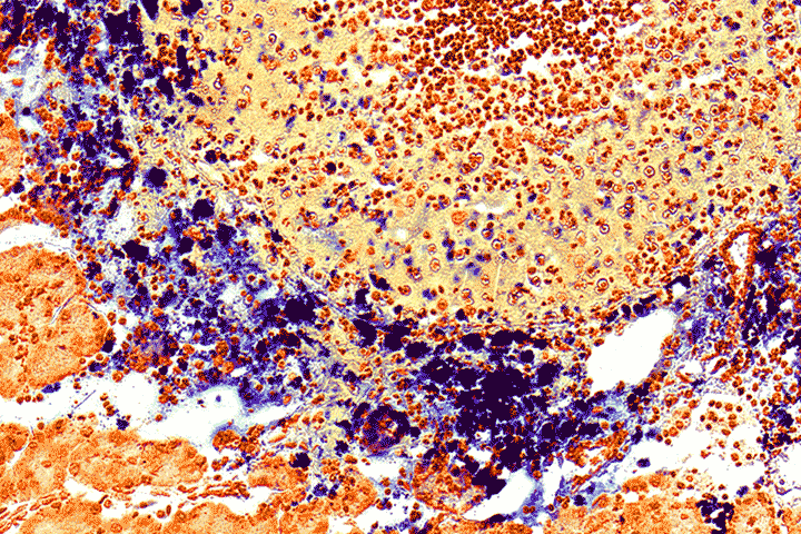 Microscopy image of a tumor section (obtained from a mouse tumor model) shows the blue-stained nanoparticles selectively accumulating in the peripheral tumor area and then penetrating into tumor cells