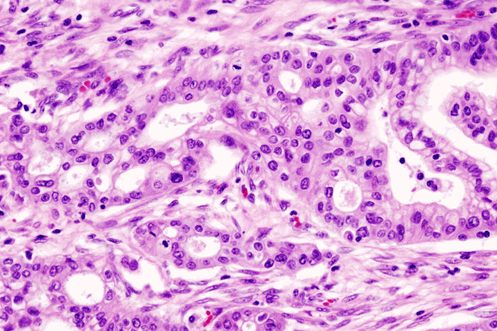 Micrograph of pancreatic ductal adenocarcinoma showing cells in pink and dark purple with white spaces between.