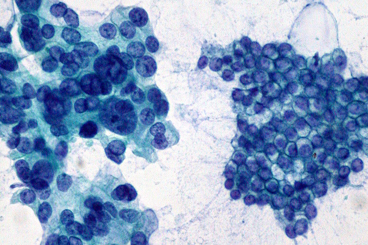 microscope image of pancreatic cancer--the blue irregular circles on the left--and normal pancreas cells--the smaller circles on the right