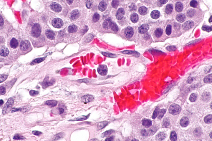 Very high magnification of a pancreatic neuroendocrine tumor in a microscope