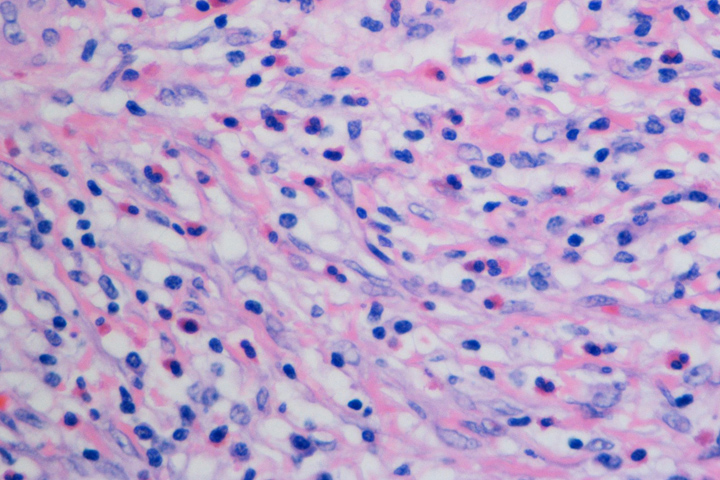 microscope slide of blue dots in a pink and white background that make up a gastric inflammatory fibroid polyp