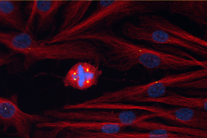 A human epithelial cell (DNA in blue) with increased numbers of centrosomes (green) amid a sea of normal cells.