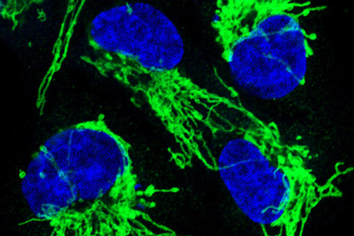 Cancer cells in green and blue