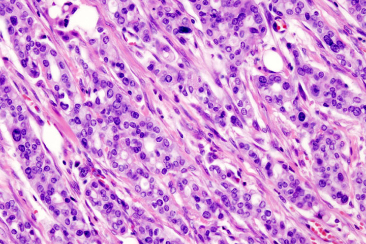 Micrograph of pancreatic ductal adenocarcinoma