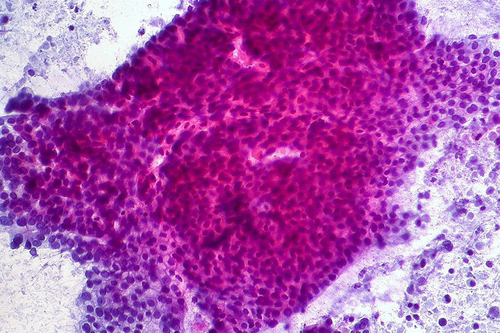 Microscope slide of adenocarcinoma, stained fuschia and purple