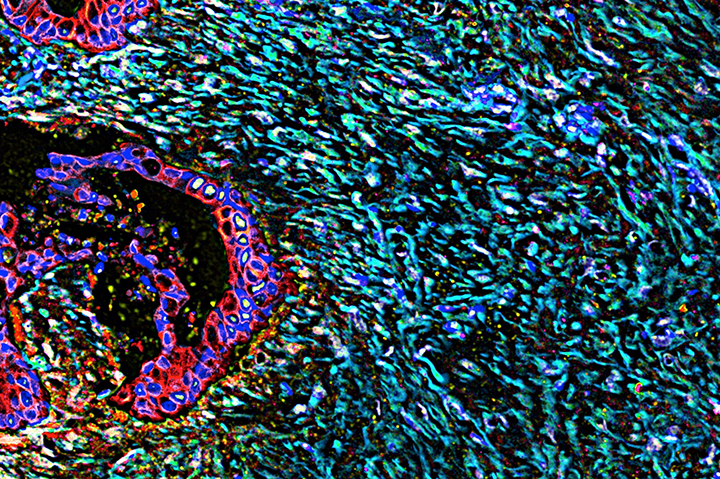 slide of pancreatic cells in bright colors