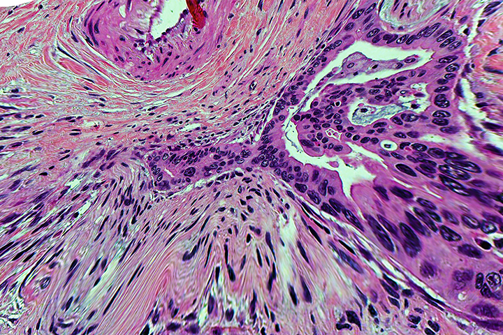 slide of pancreatic cancer near a nerve