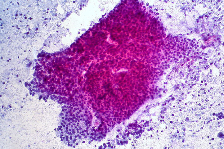 Slide of pancreatic cancer