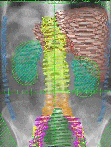 radiation of the whole abdomen