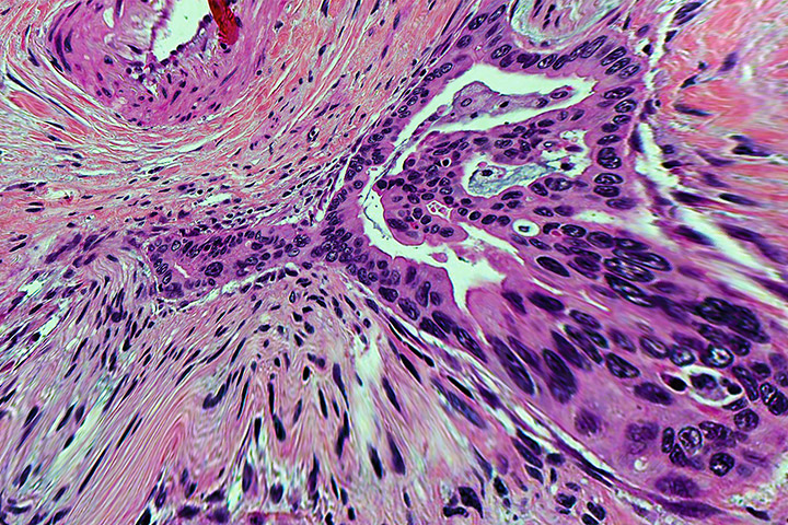 slide of pancreatic cancer