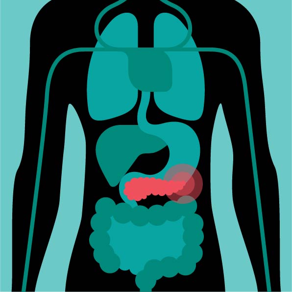 Pancreatitis - Pancreatic Neuroendocrine Tumors (PNET)